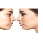 Reduce spots in 2 days