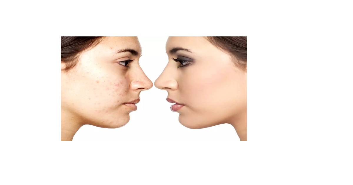 Reduce spots in 2 days
